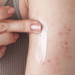 La dermatitis atopica